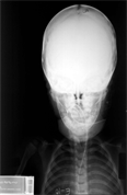 Katie West Autopsy XRay
