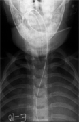 Katie West XRay, Clear Airway No Swelling